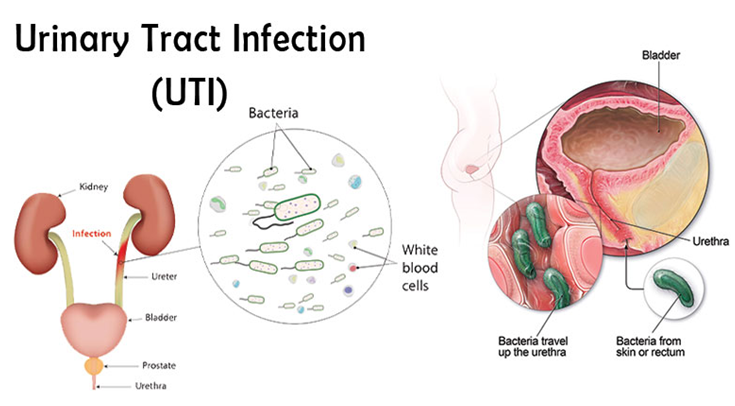 UTI Infection